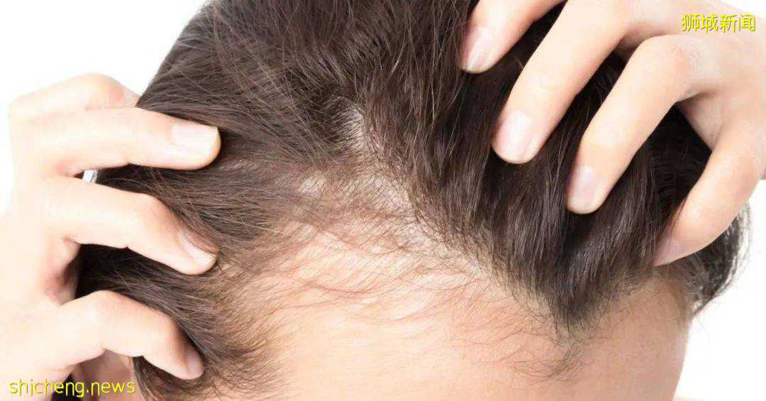 新加坡有人打完2針疫苗後,狂掉頭發!禿了