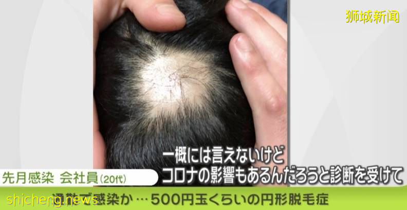 新冠长期后遗症竟有200多种!新加坡一起死亡病例被室友传染,确诊到死亡仅5天