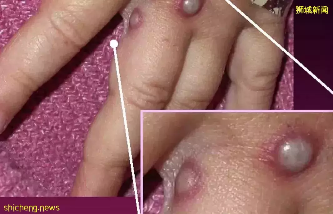 突發!新加坡組屋現不明肺結核感染群,2人死亡!多國曝“新冠+天花”病例,人畜共通