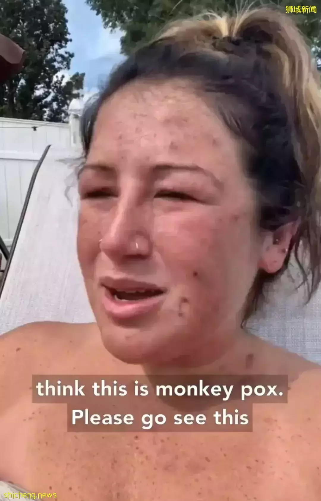 新加坡发现首起本土猴痘病例，源头成谜！患者实拍自述感受！这次会学中国吗
