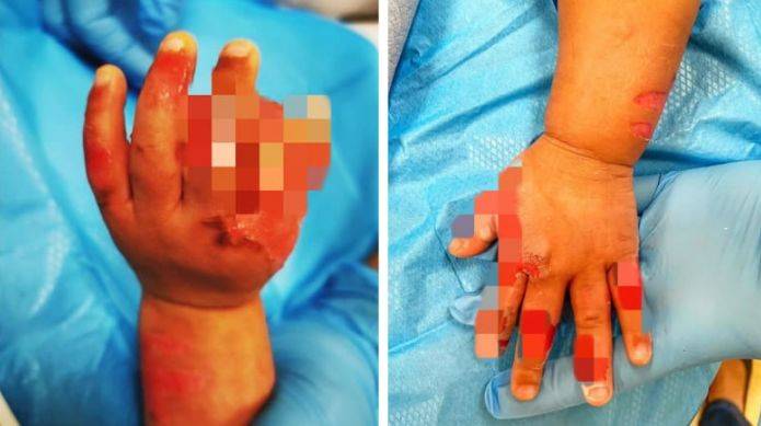 新加坡17個月寶寶手被女傭放鍋裏煮,皮開肉綻!判坐牢14個月