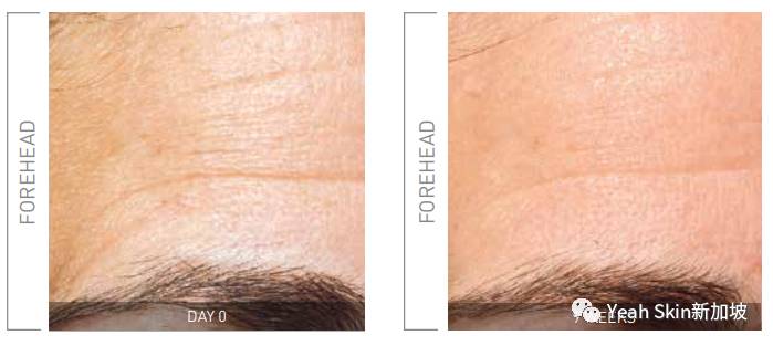 三重福利！贵妇级院线抗衰护理——法国FILLMED来新加坡啦