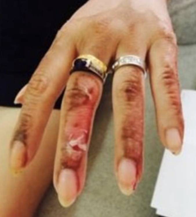 6年前,她在新加坡的中餐馆被毁容!最终获赔10万新币