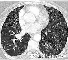 新冠還未過去，更可怕的“新冠後遺症”悄然降臨！新加坡已有客工出現症狀