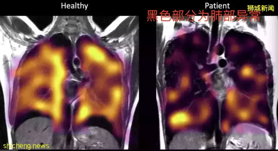 新加坡病例神秘減半,原因在這!57國發現"奧妹",死亡患者肺部高清照片首曝光