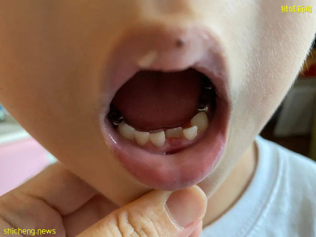 5歲女童拔牙後腦死亡！你還敢隨便在新加坡給孩子拔牙嗎