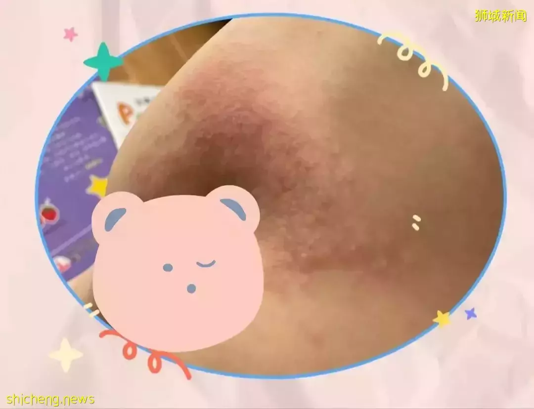 新冠疫情副作用顯現:據說去年這種疫病的患者上升了20%