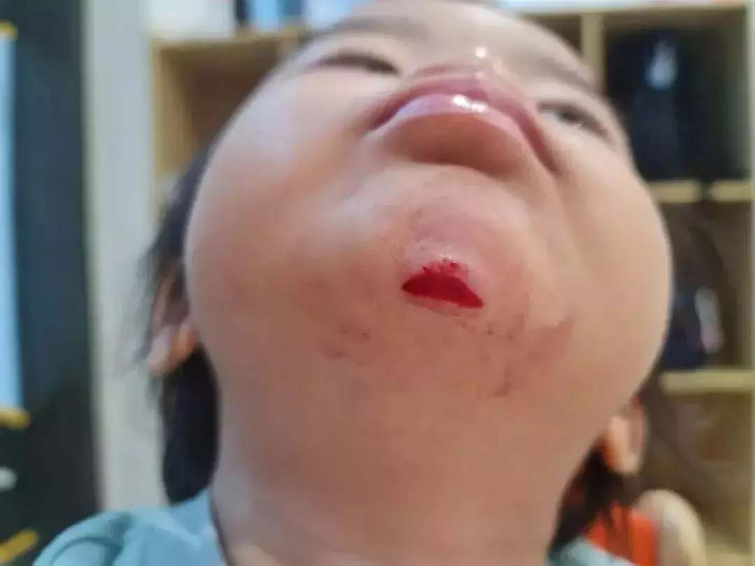 揪心!“1岁多女儿在新加坡幼儿园受伤缝6针,学校的态度令人心寒……”