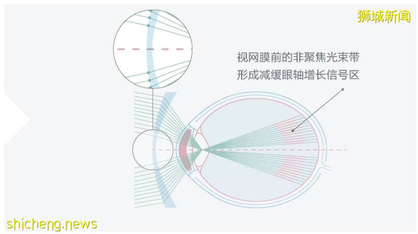 喜大普奔！防控孩子近視的“黑科技”鏡片，終于來新加坡啦