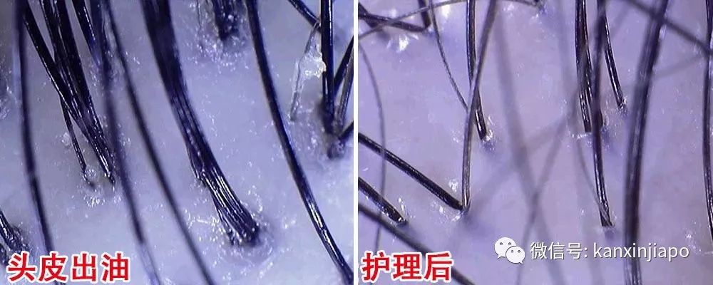 在线等，急！新加坡让我的头皮变大油田，怎么办？