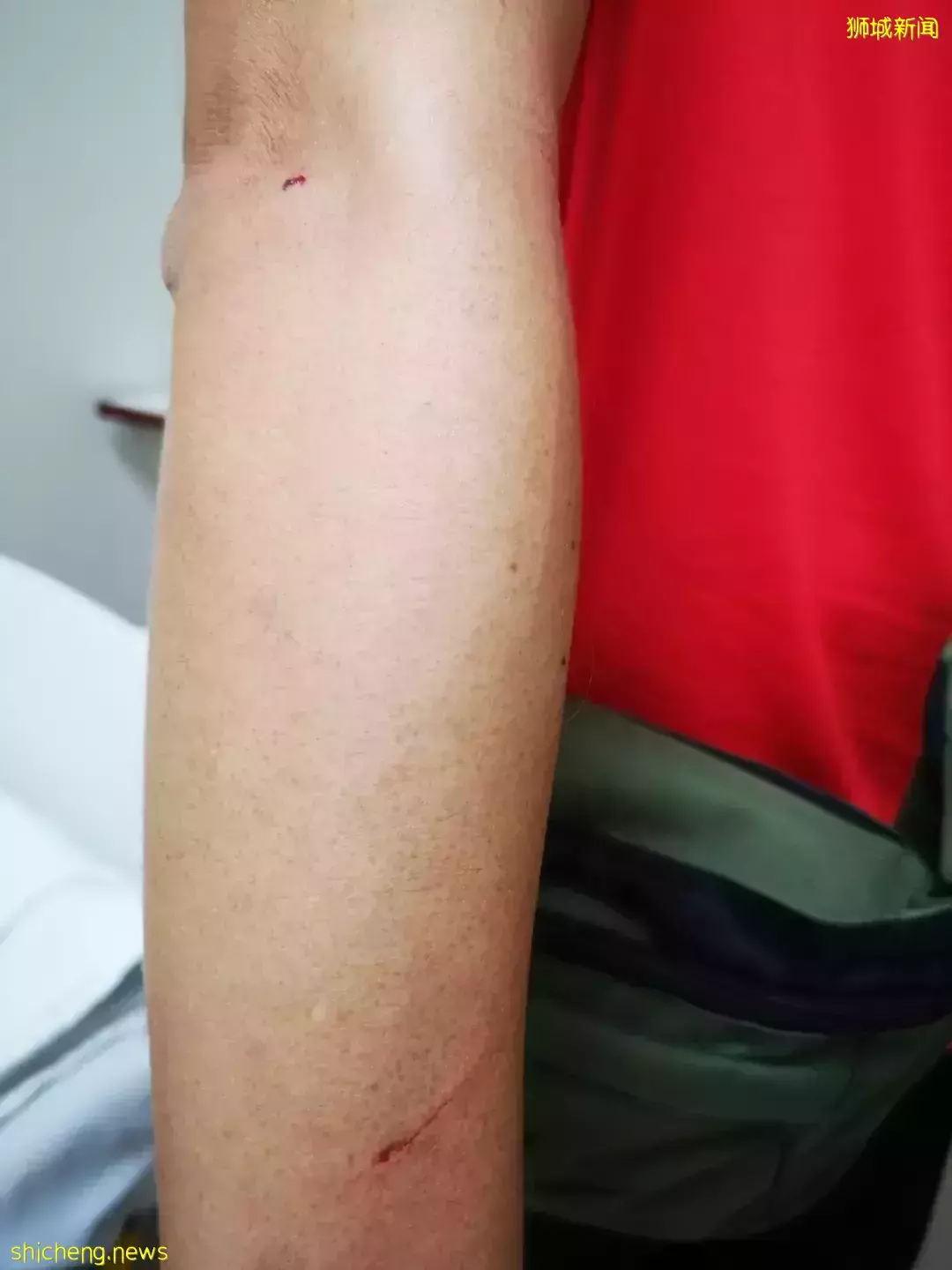 新加坡3歲女童被寵物孔雀啄傷，血流不止，臉上留下3厘米縫合線