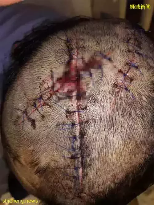 遭陌生人追砍 三道疤痕 觸目驚心!