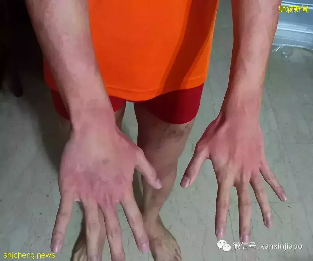 全身奇痒无比,新冠也能引起皮肤病