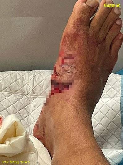 脚掌被鱼咬成大窟窿 船长缝30针住院6天