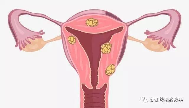 肥胖：女性不孕的隐形杀手！