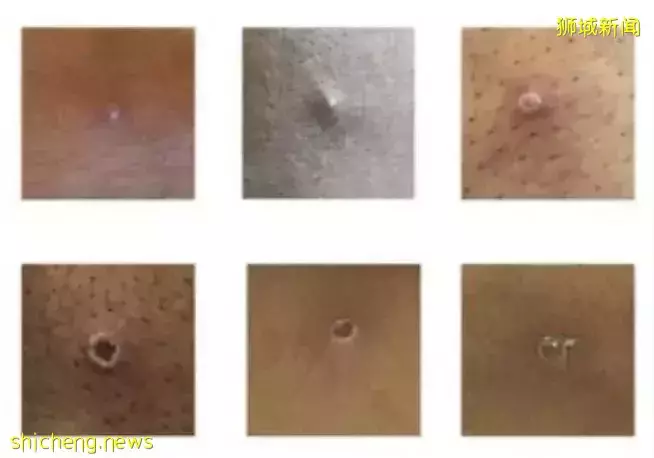 突發!新加坡組屋現不明肺結核感染群,2人死亡!多國曝“新冠+天花”病例,人畜共通