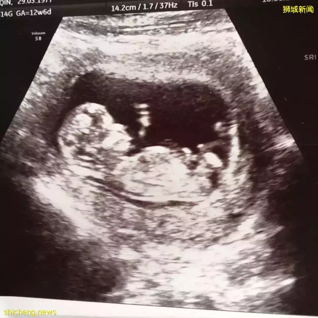 “我39岁时,在新加坡怀二胎中风,差点丢命……”