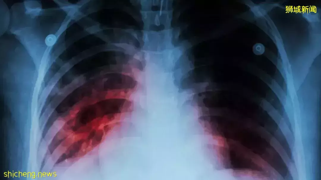 突發!新加坡組屋現不明肺結核感染群,2人死亡!多國曝“新冠+天花”病例,人畜共通