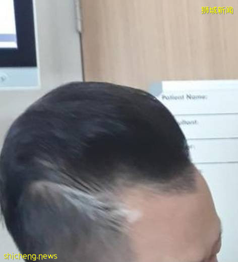 新加坡男子接种疫苗后脱发!还好最终长回来了