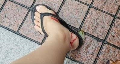 水獭滨海湾花园使坏 狠咬少妇脚踝 缝3针