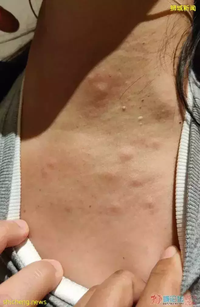 客人在新加坡住酒店遭臭虫咬伤苦不堪言,僵持过后酒店同意全额退款