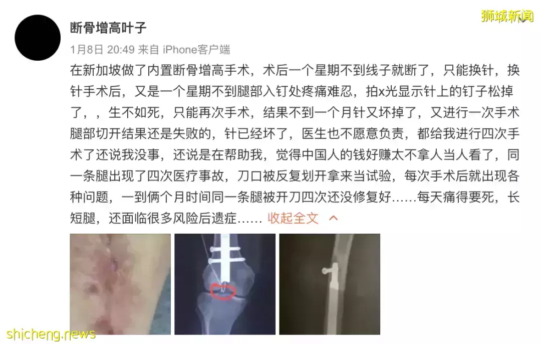 新加坡医生回应!中国女子控诉花50万做“断骨增高”手术失败