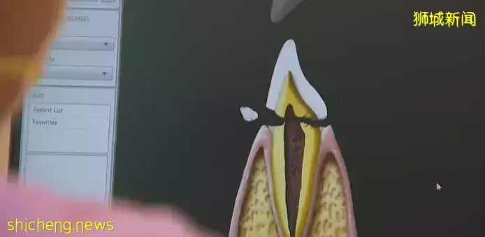 牙医：多达两成病人因牙裂问题前来看诊