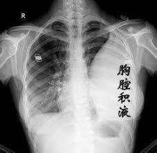 新加坡老人身患重症后又感染新冠!他选择在家去世