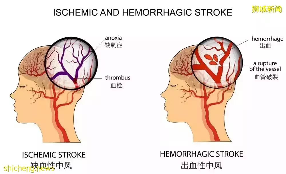 “我39岁时,在新加坡怀二胎中风,差点丢命……”