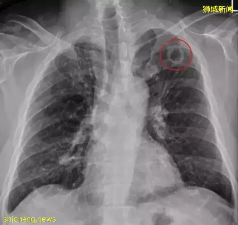 这些人强制检测！新加坡一条街区曝170例肺结核，或出现新传播链！他的左上肺出现破洞