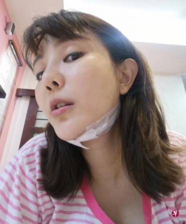 大腿突瘀青再变疼痛 童缤毓明动手术切除肿块