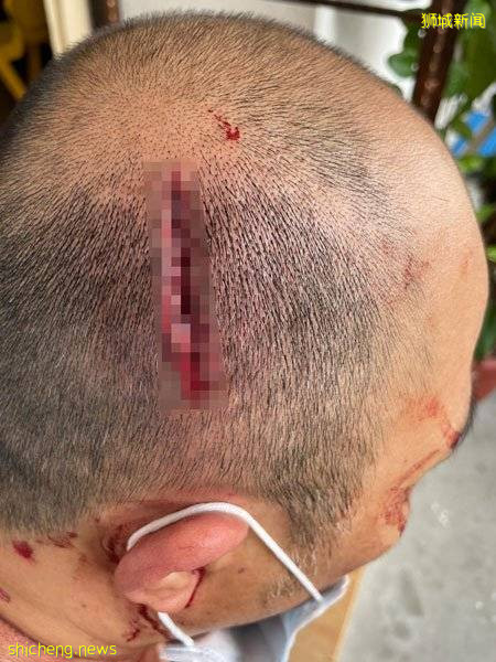 六旬阿叔不满脚踏车遭移动  挥2次“流星锤” 中年汉缝5针