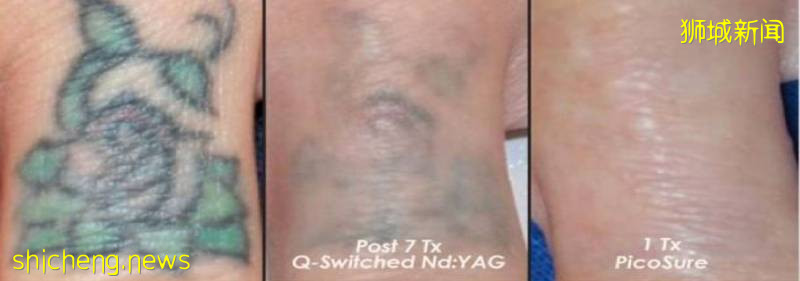 “我在新加坡體驗風靡中韓的醫美,堪比換臉!價格亮了~”