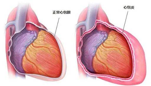 接種第二劑疫苗後，一周內不要劇烈運動