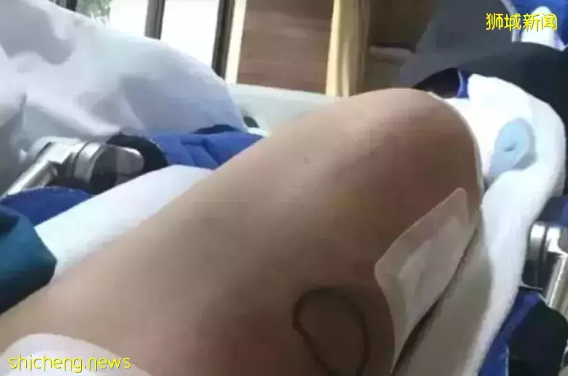 中国妹纸迷恋“增高术”冒疫情飞新加坡手术，结果成了长短腿、差点截肢