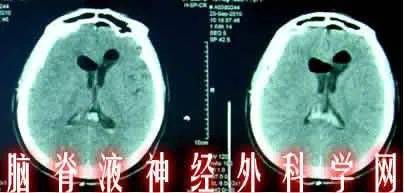 李光耀女儿李玮玲自曝患有罕见的脑部疾病，10万人仅有5人患病