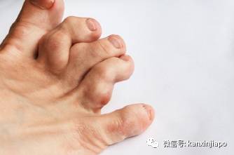 新加坡智障女两年惨遭朋友开水烫身,链绑手脚,铁锤打破10颗牙