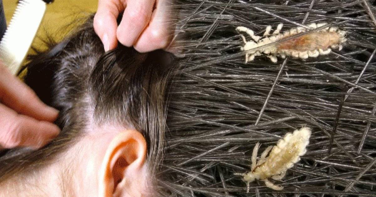 頭皮誤診爲頭虱 半數同學被送回家