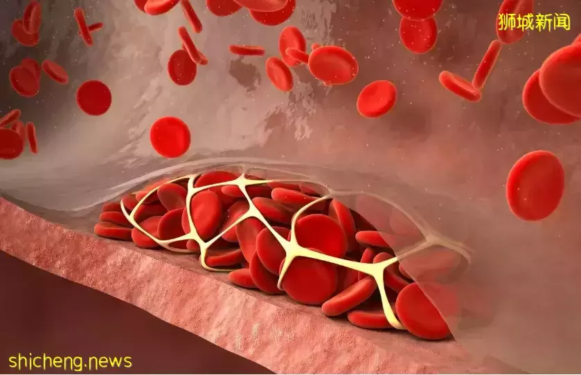 確診後6個月內患血栓風險高,輕症患者也不例外