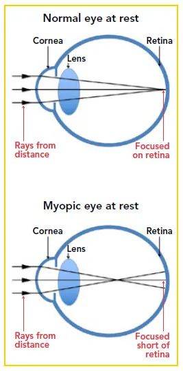 爲何這麽多人求著代購這款‘新加坡眼藥水’