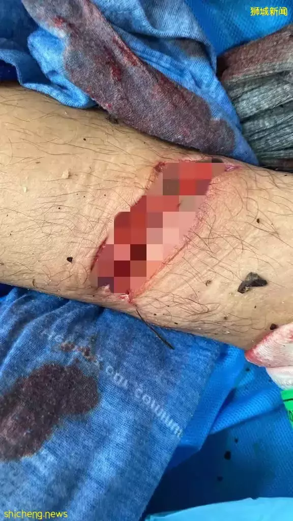 下武吉知马山摔伤见骨 餐饮集团老板脚缝49针