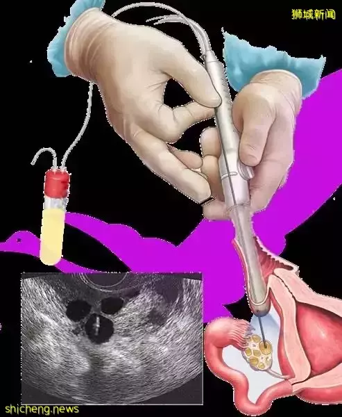 新加坡允许未婚女性做冻卵! 附费用和流程指南