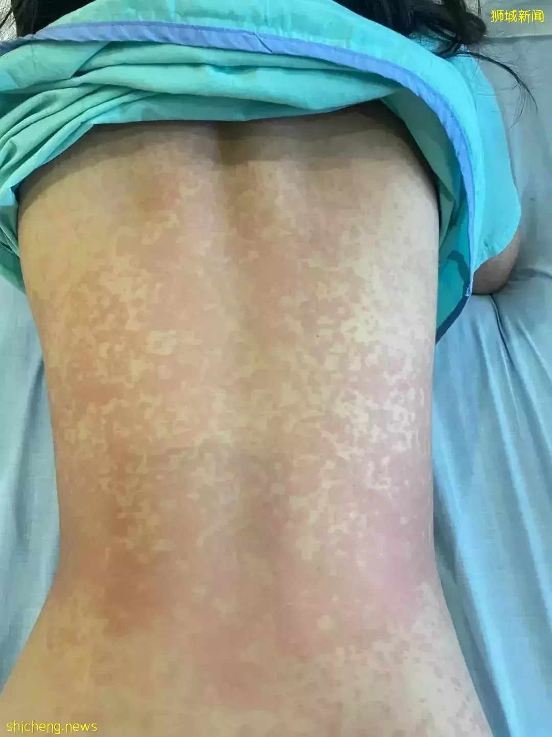 紧急求助！“娃全身红疹，被新加坡医生要求全麻开刀！我该怎么办？”