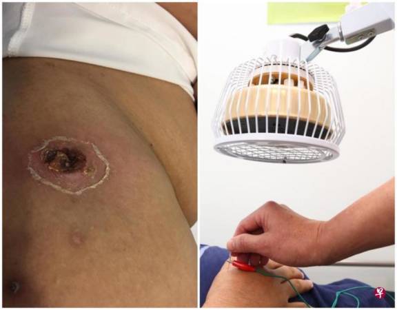 女文员针灸 屁股"灼"出一个洞