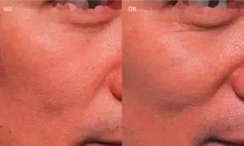 “我在新加坡體驗風靡中韓的醫美,堪比換臉!價格亮了~”