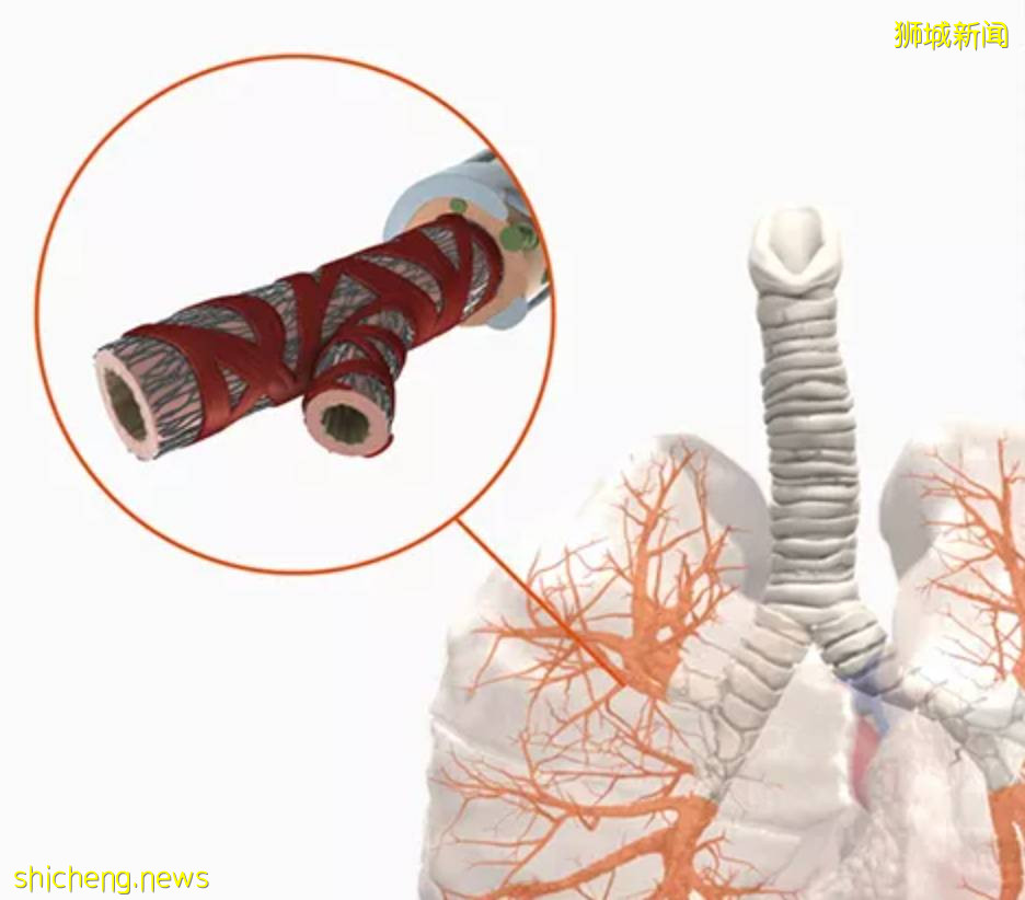 網上瘋傳:新加坡對新冠病人屍檢後修改治療方案