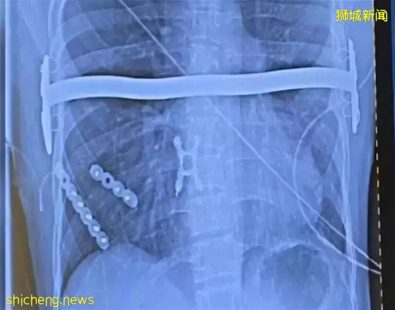 狮城医院3D打印胸腔　医治胸部畸形男子