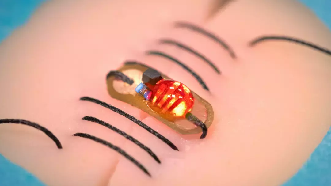 NUS 團隊發明智能縫合線，以檢測深層術後傷口變化