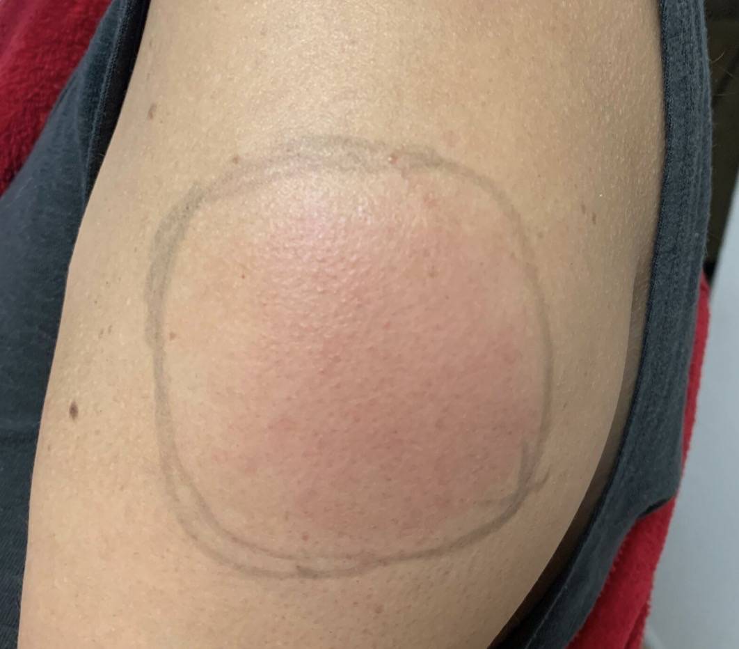 新加坡批准莫德納疫苗!深扒副作用:肌肉腫大、發燒39.4度