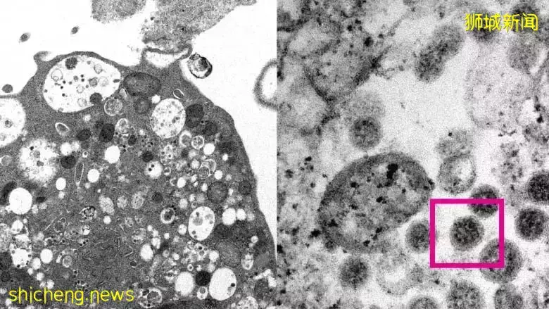 新加坡病例神秘減半,原因在這!57國發現"奧妹",死亡患者肺部高清照片首曝光